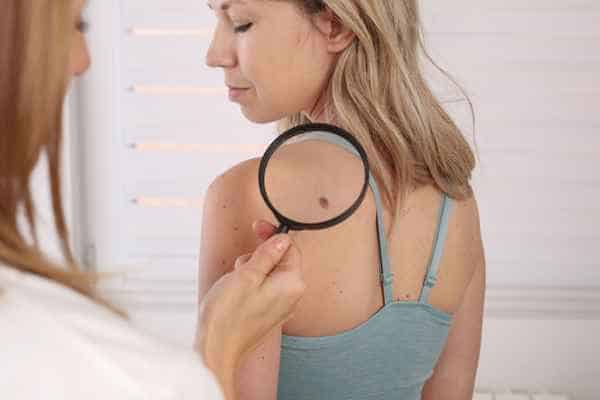 What Are Traditional Skin Lesion Removal Methods Yeading?