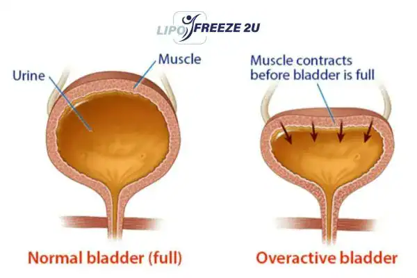 diagram of overactive bladder treatment Yeading