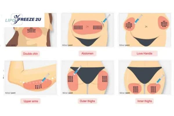 Benefits of Choosing Aqualyx for Fat Reduction Yeading