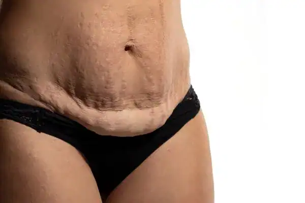 loose skin after weight loss injections Yeading