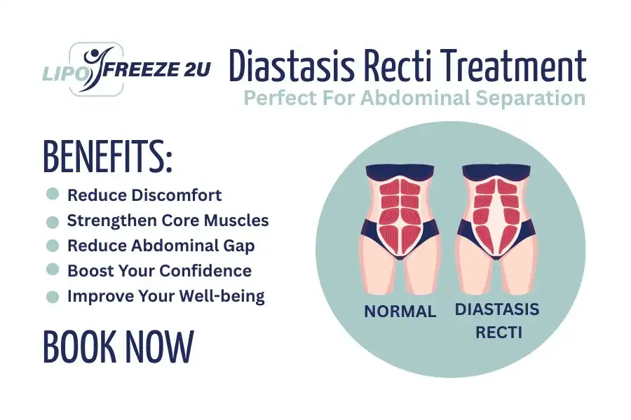 How Long Will It Take to See Improvements in Diastasis Recti Yeading
