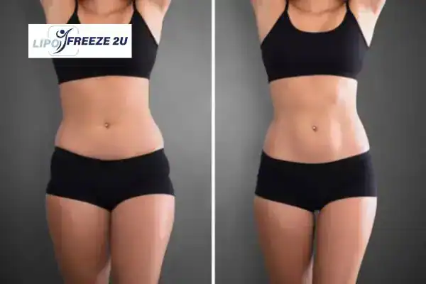 How Can LIPO FREEZE 2U Support Your Post-Pregnancy Body Recovery Yeading?