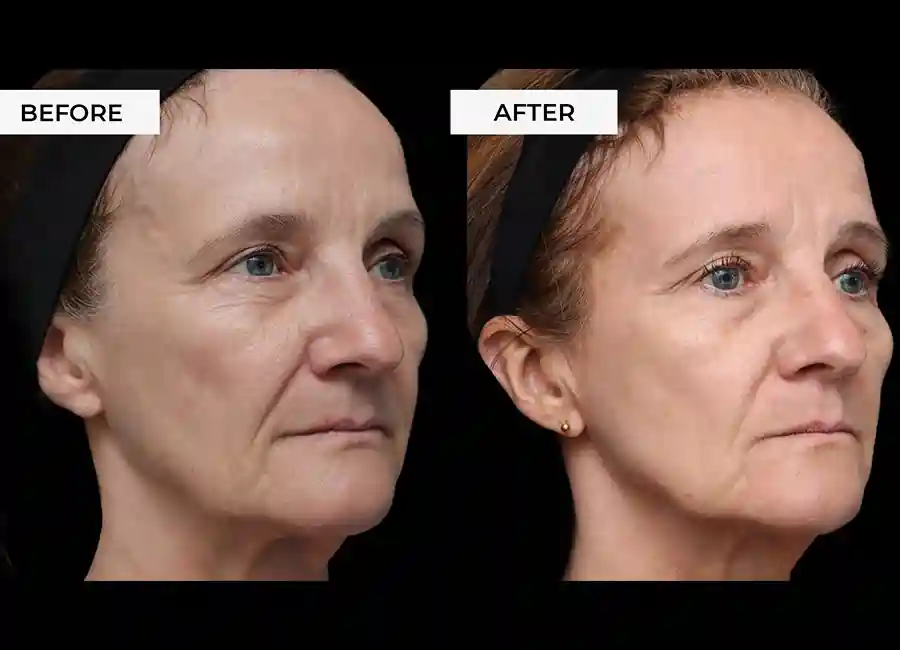 How Many RF Microneedling Sessions Will You Need to See a Difference Yeading?