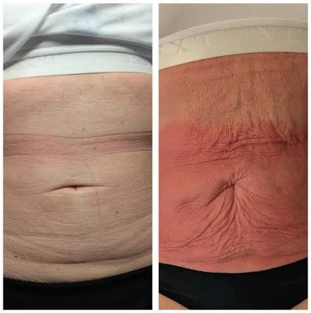 How Does RF Microneedling Improve Crepey, Thin and Uneven Skin Texture Yeading?