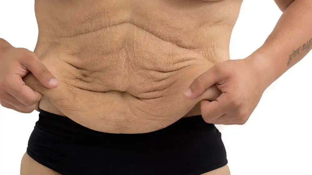 RF Microneedling for Loose Skin: How Can It Help Tighten and Reshape the Skin Yeading?
